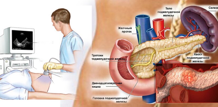 ЗОЖ 7. Панкреатит. Причины, профилактика, восстановление