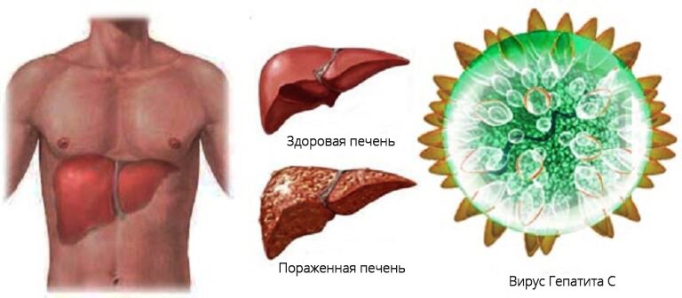 ЗОЖ 5. Гепатиты. Причины, профилактика, восстановление