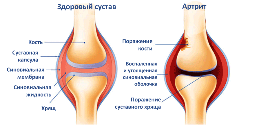 ЗОЖ 1. Артриты и артрозы. Профилактика, восстановление
